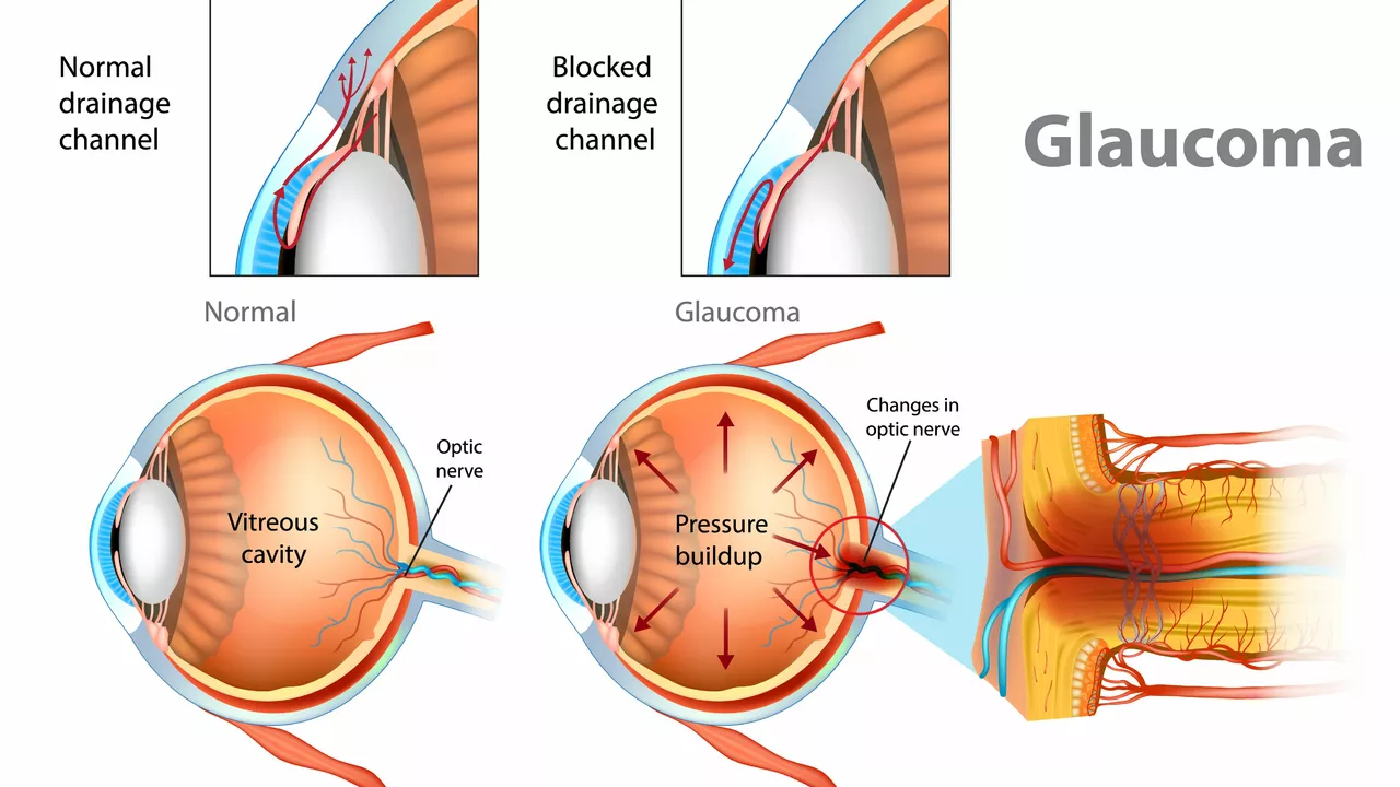 Understanding Open-Angle Glaucoma: Causes, Symptoms, and Treatment Options